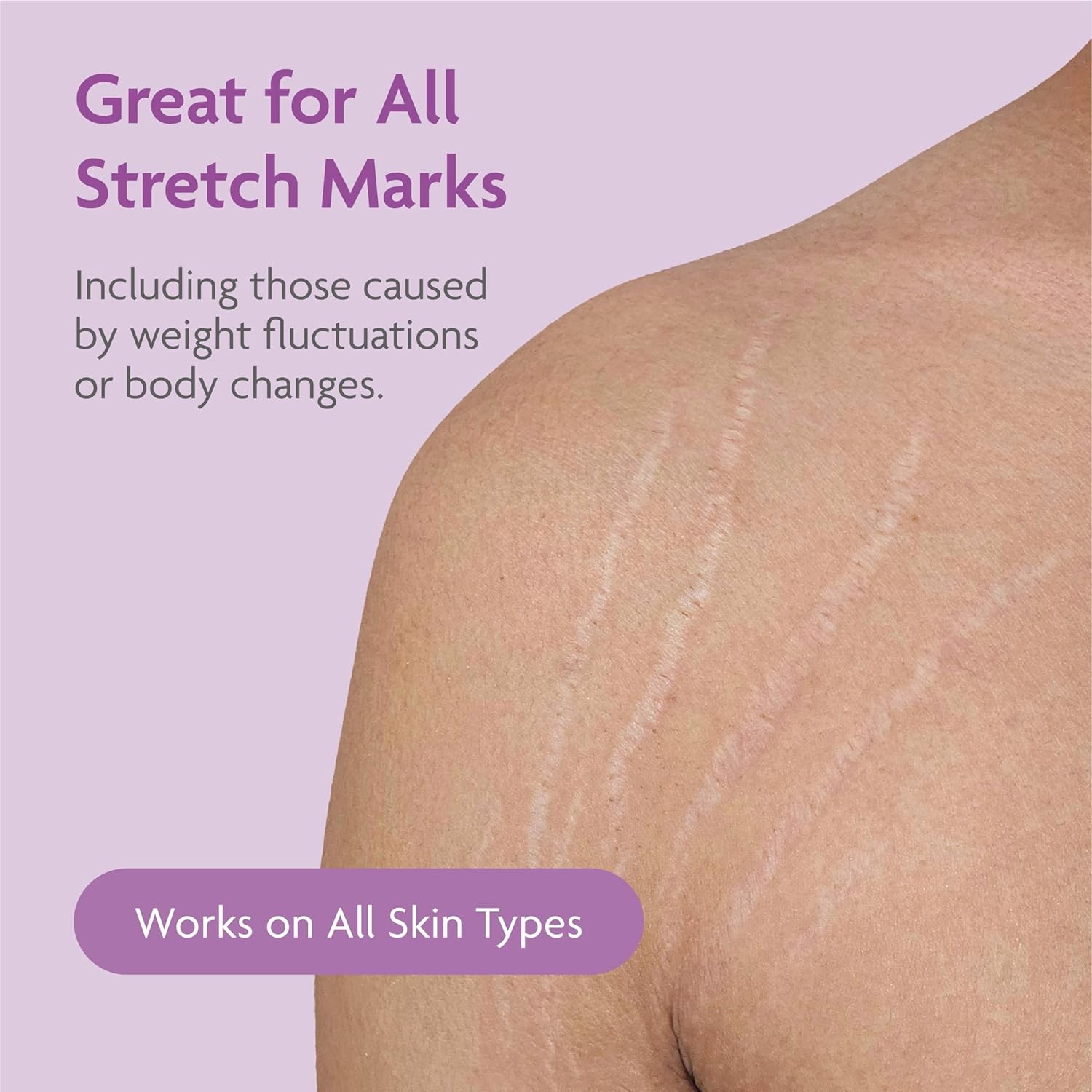 TriLASTIN Stretch Mark Cream ?C Collagen & Elastin Support Body Cream with Niac
