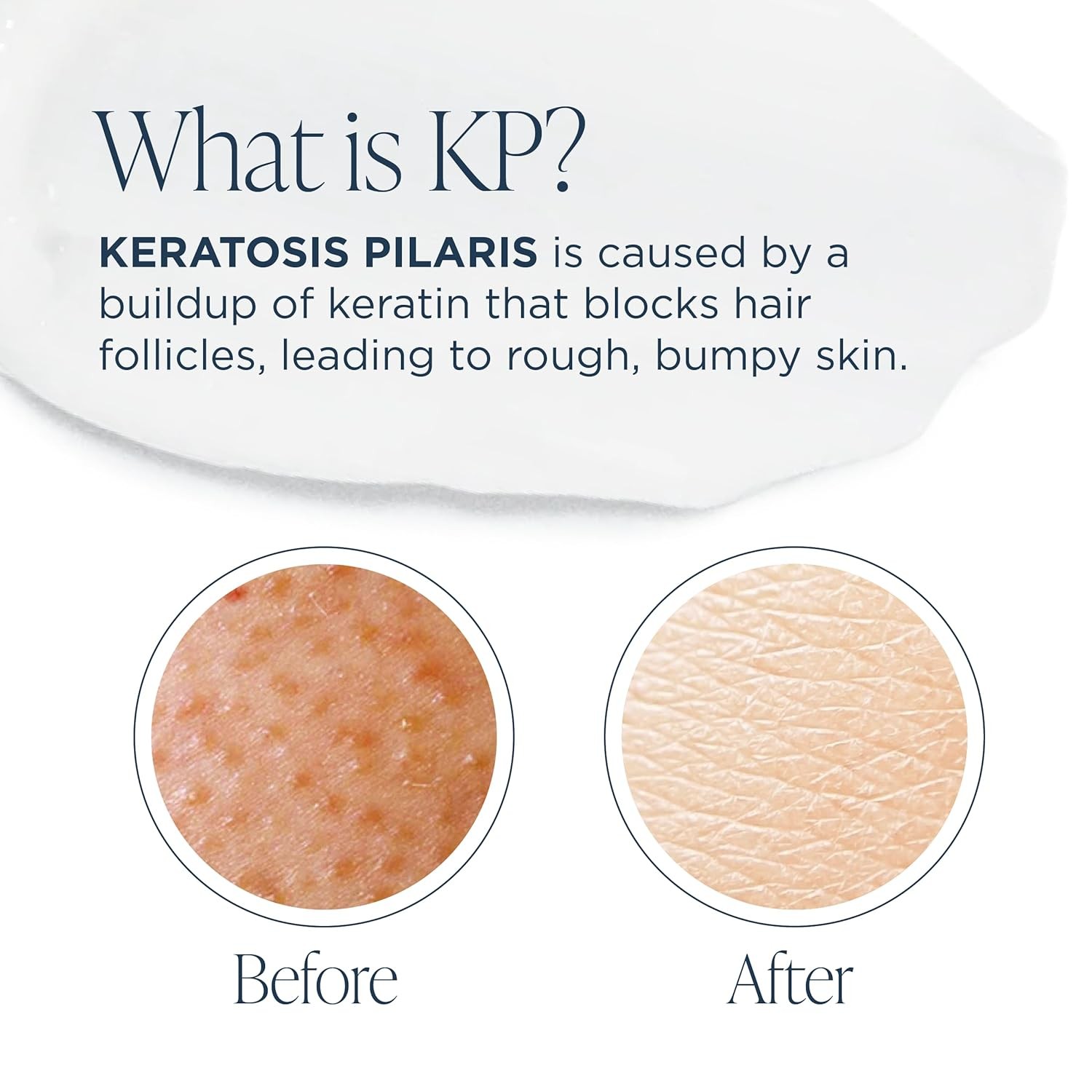 Glytone KP Kit ?C Exfoliating Body Wash, Glycolic Acid Lotion & Shower Pouf for